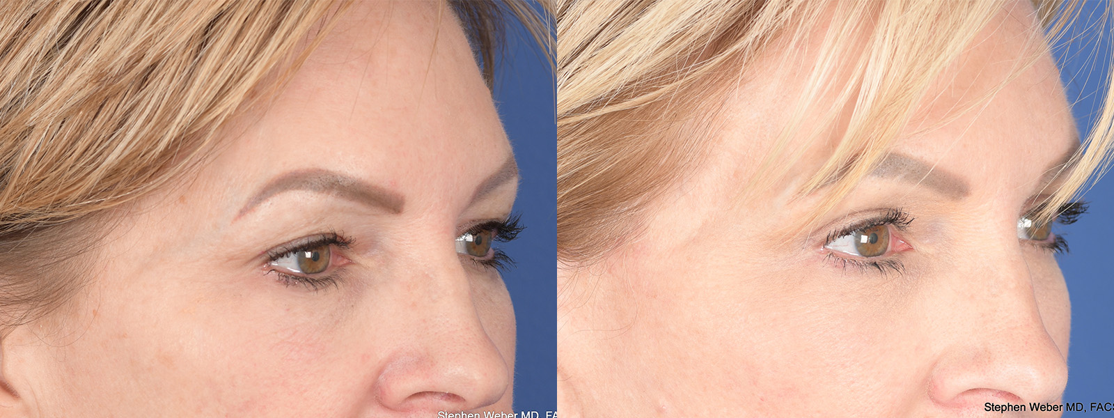 Blepharoplasty Before and After | Weber Facial Plastic Surgery