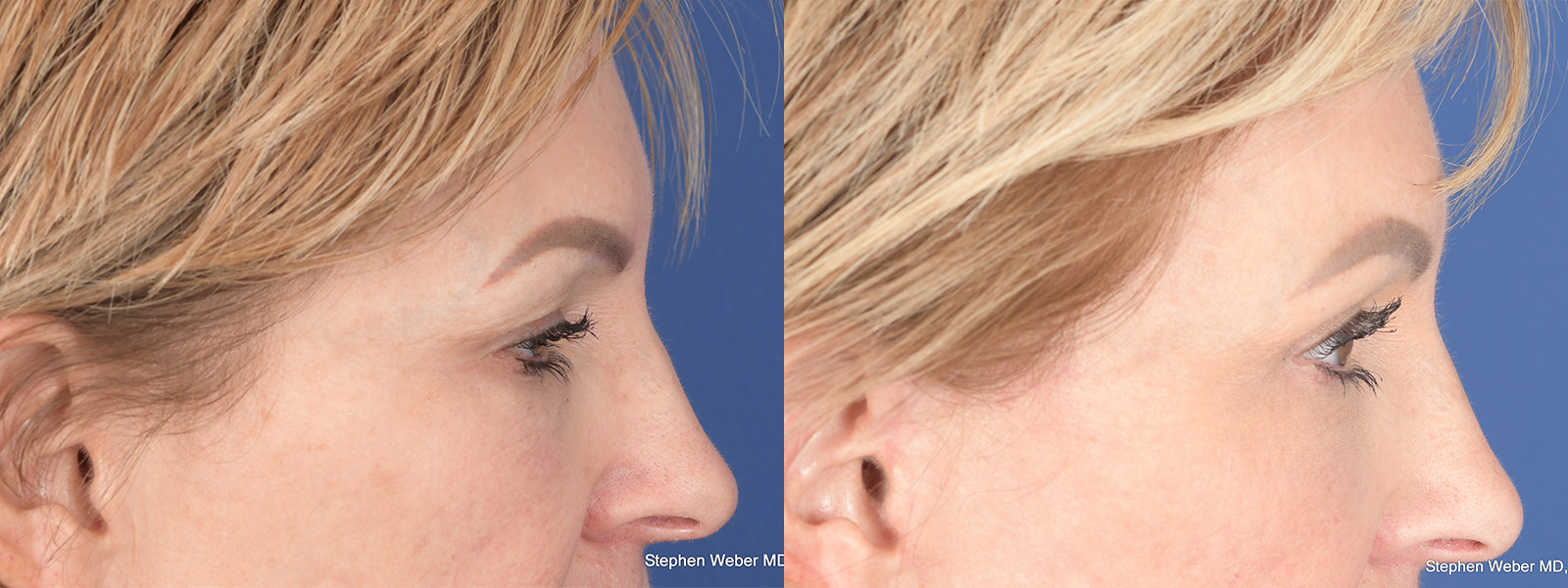 Blepharoplasty Before and After | Weber Facial Plastic Surgery