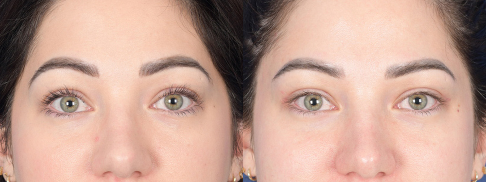 Blepharoplasty Before and After | Weber Facial Plastic Surgery