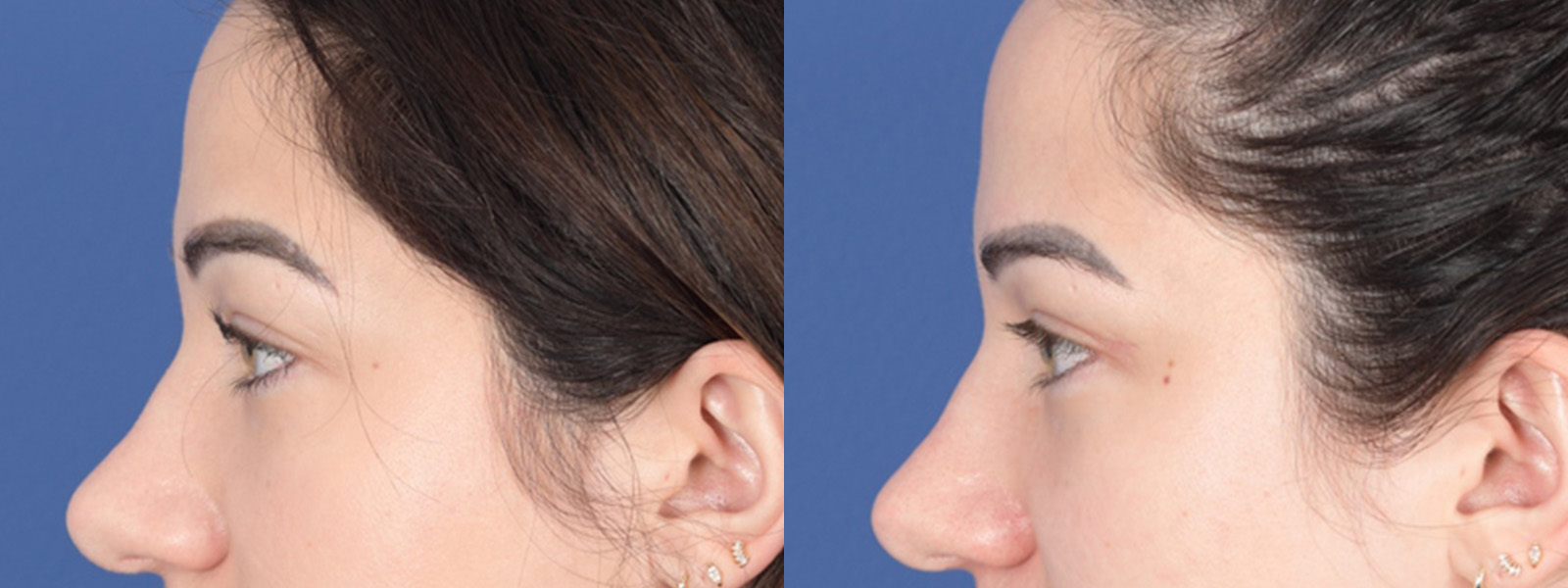 Blepharoplasty Before and After | Weber Facial Plastic Surgery
