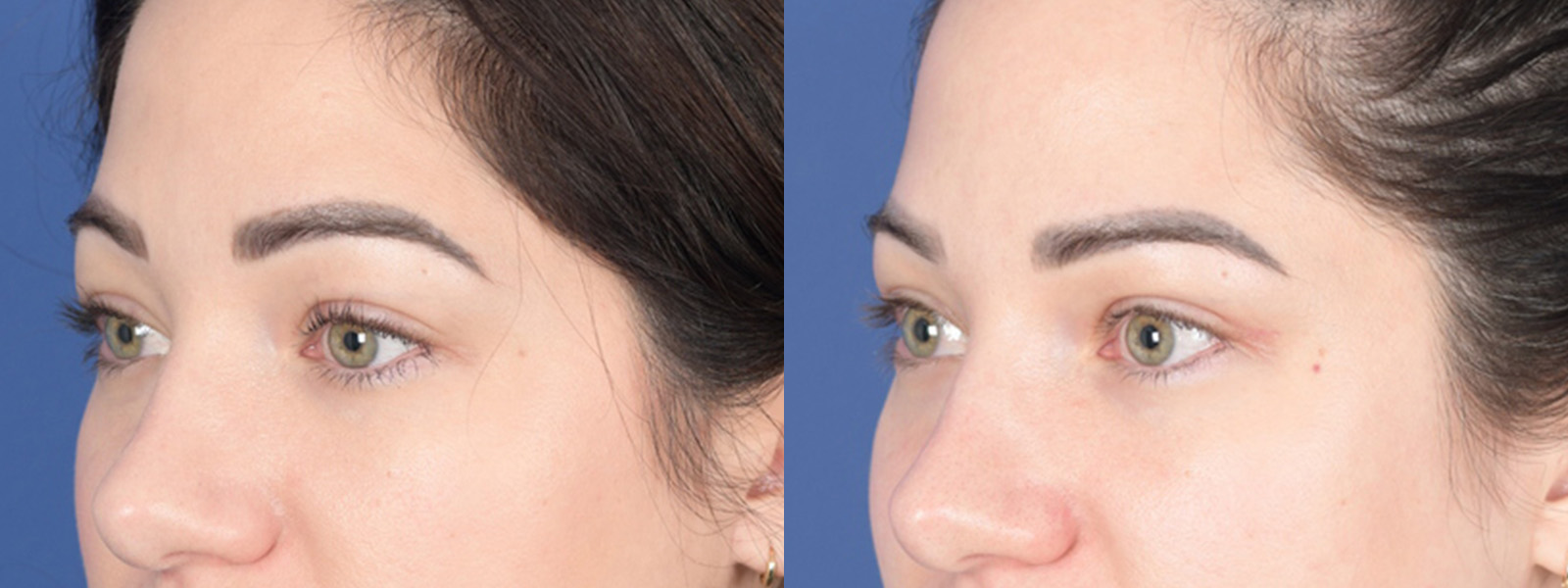 Blepharoplasty Before and After | Weber Facial Plastic Surgery