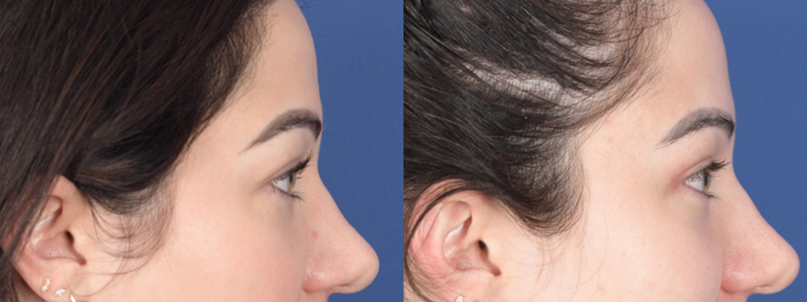 Blepharoplasty Before and After | Weber Facial Plastic Surgery