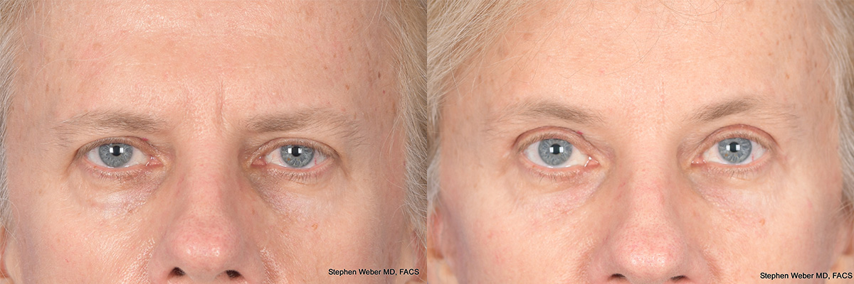 Before and After Eyelid Surgery in Denver 2