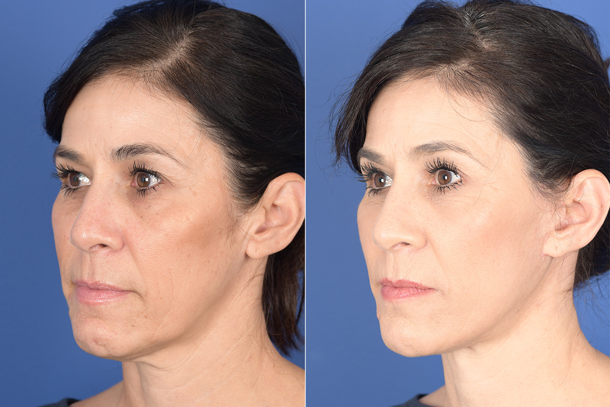 Blepharoplasty Before and After | Weber Facial Plastic Surgery