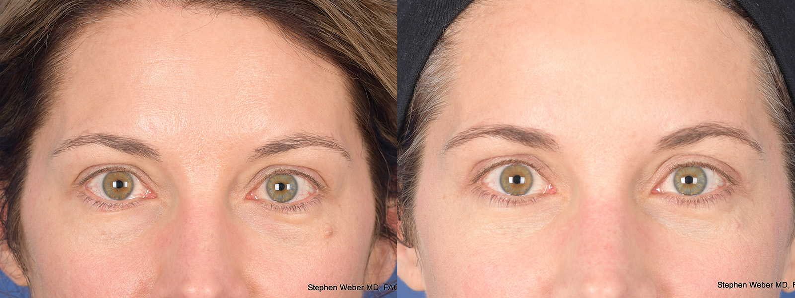 Blepharoplasty Before and After | Weber Facial Plastic Surgery