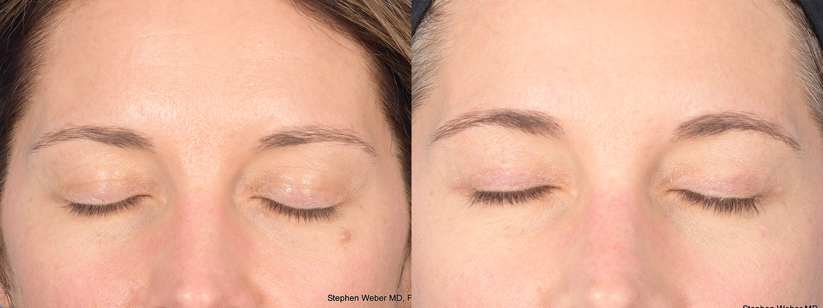 Blepharoplasty Before and After | Weber Facial Plastic Surgery