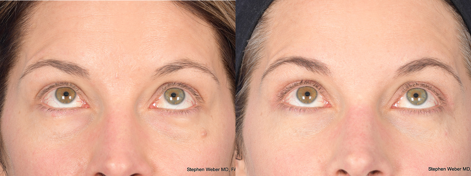 Blepharoplasty Before and After | Weber Facial Plastic Surgery