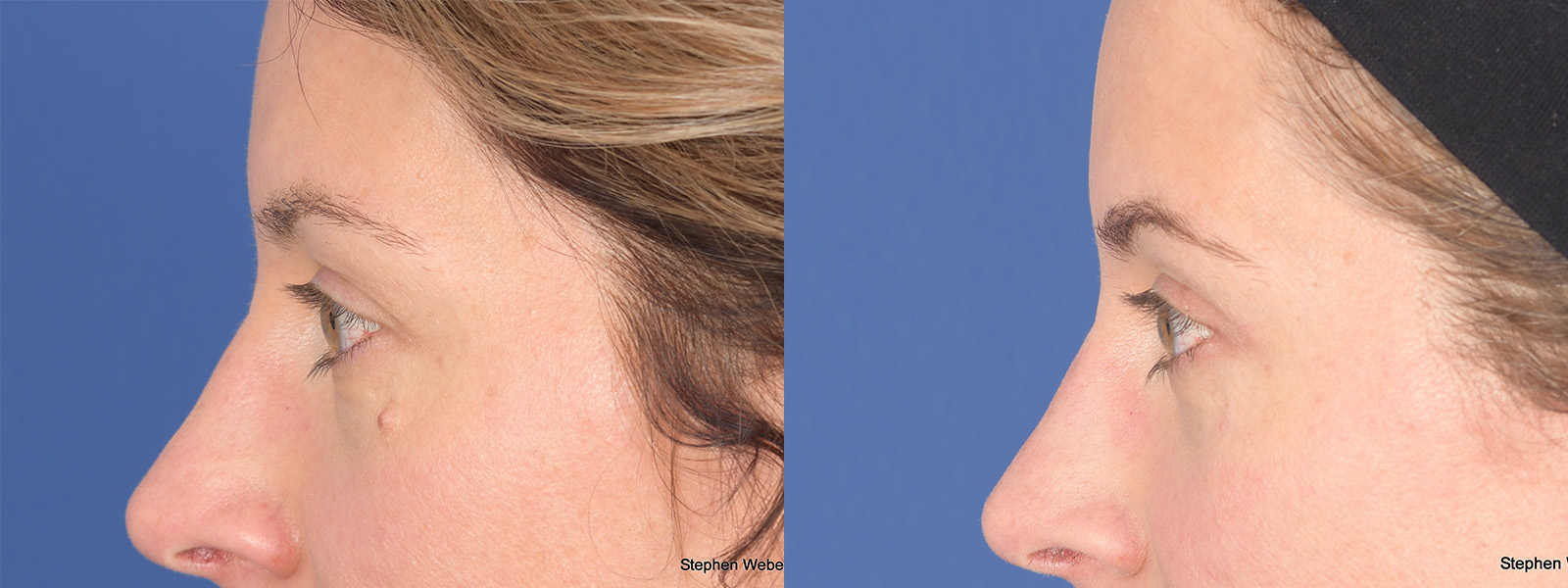 Blepharoplasty Before and After | Weber Facial Plastic Surgery