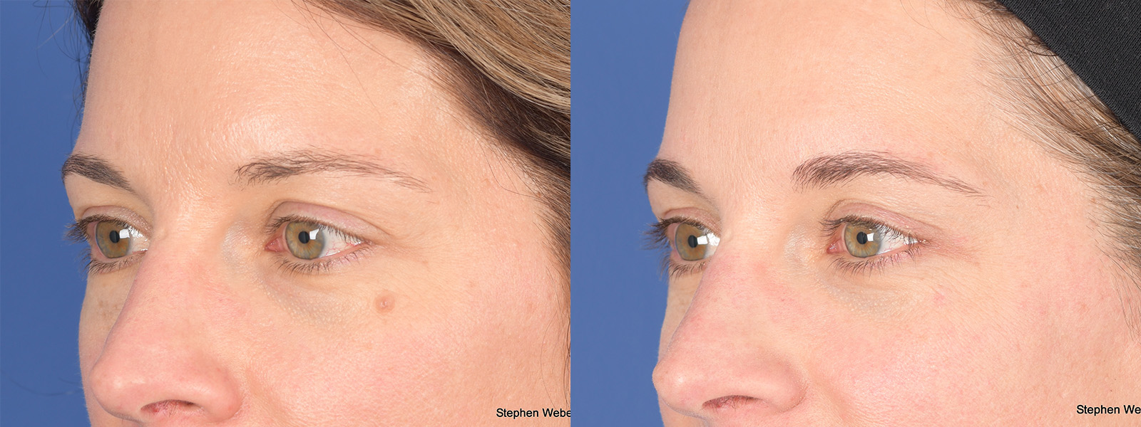 Blepharoplasty Before and After | Weber Facial Plastic Surgery