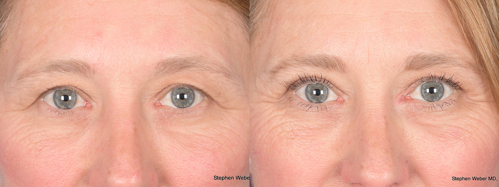 Blepharoplasty Before and After | Weber Facial Plastic Surgery