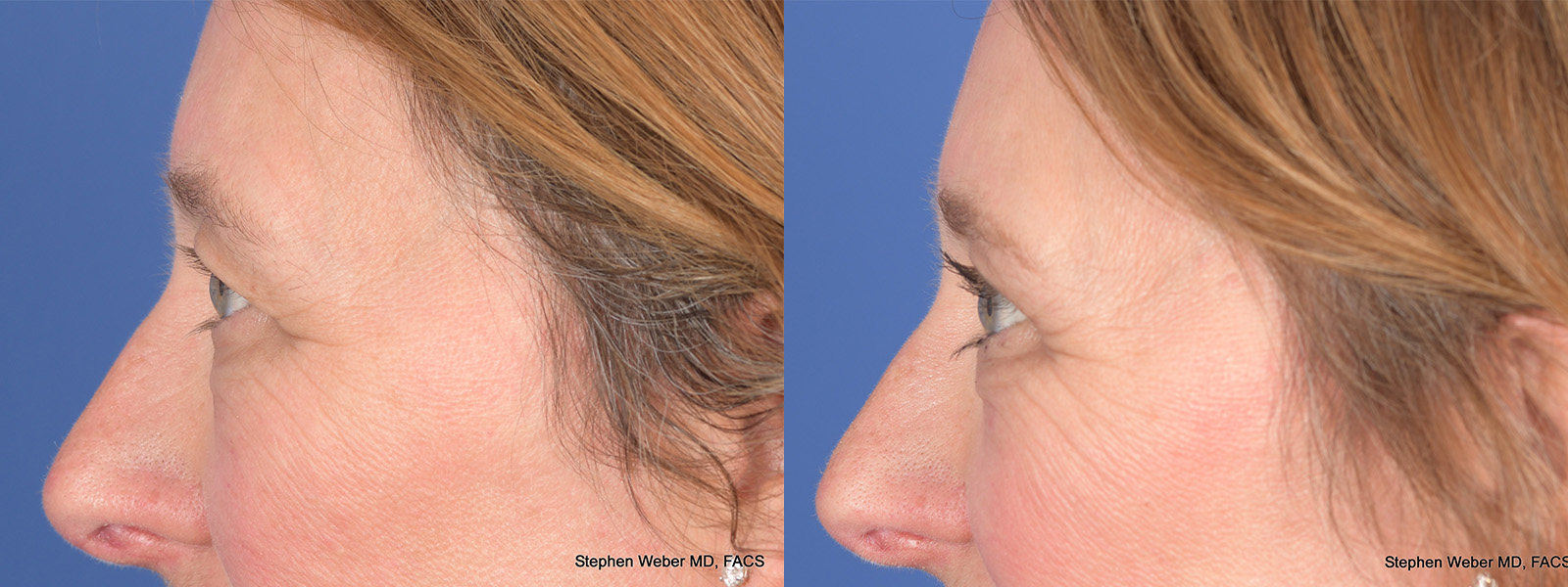Blepharoplasty Before and After | Weber Facial Plastic Surgery