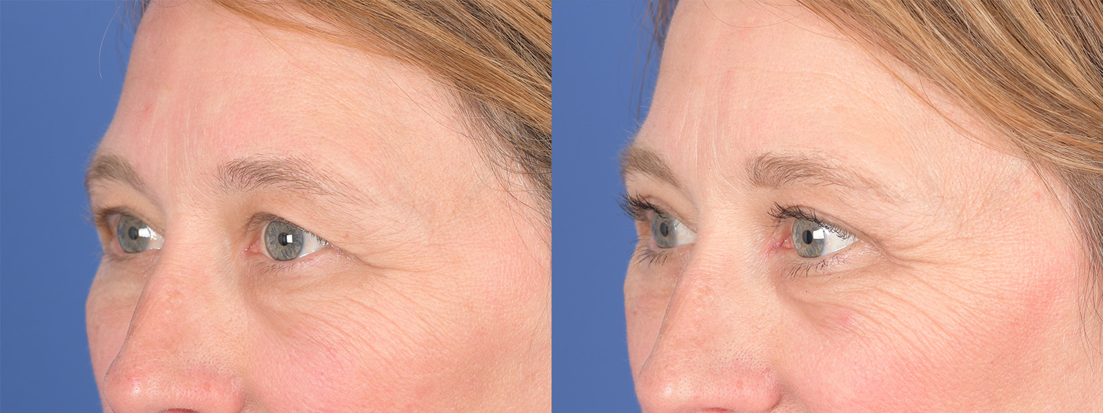 Blepharoplasty Before and After | Weber Facial Plastic Surgery