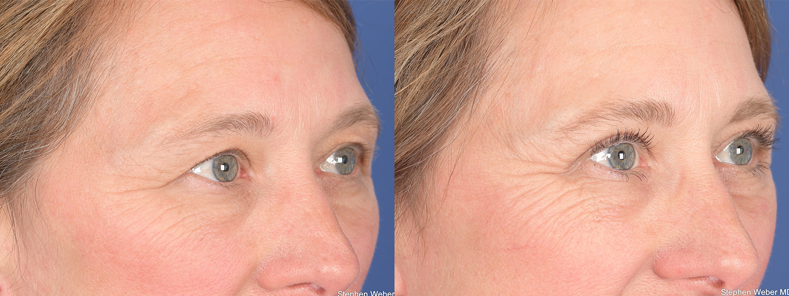 Blepharoplasty Before and After | Weber Facial Plastic Surgery