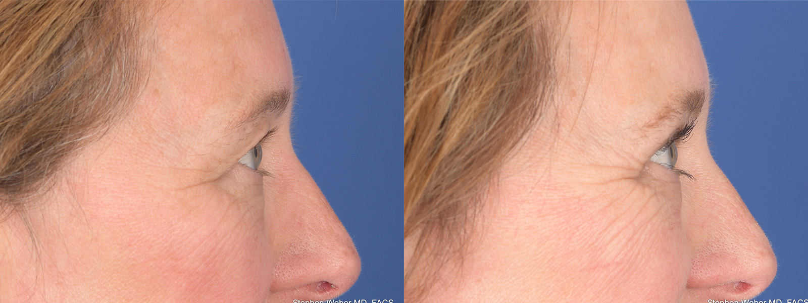 Blepharoplasty Before and After | Weber Facial Plastic Surgery