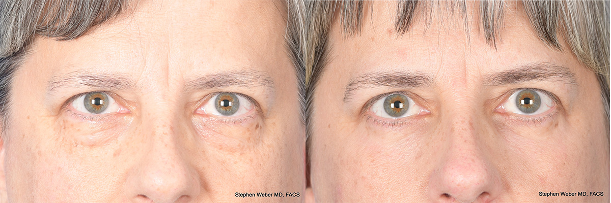 Blepharoplasty Before and After | Weber Facial Plastic Surgery