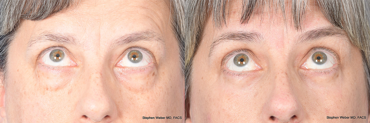 Blepharoplasty Before and After | Weber Facial Plastic Surgery