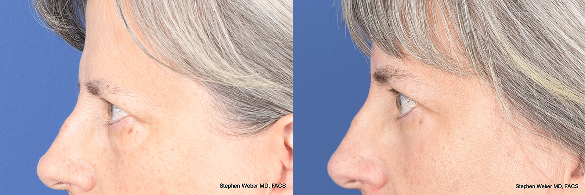 Blepharoplasty Before and After | Weber Facial Plastic Surgery
