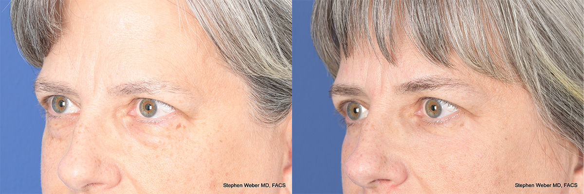 Blepharoplasty Before and After | Weber Facial Plastic Surgery
