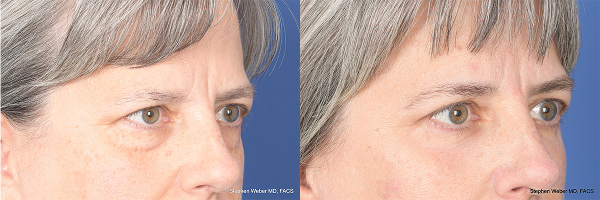 Blepharoplasty Before and After | Weber Facial Plastic Surgery