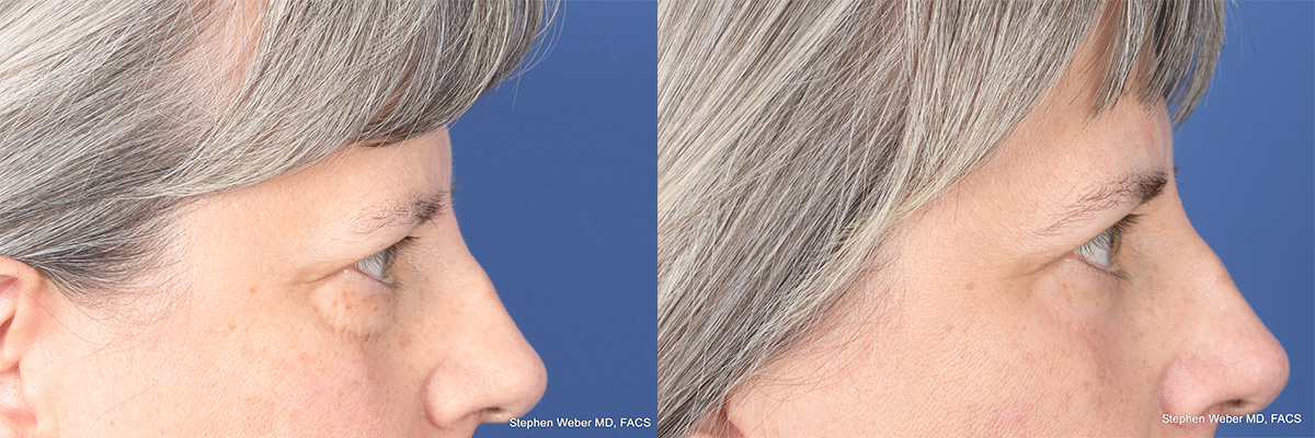 Blepharoplasty Before and After | Weber Facial Plastic Surgery