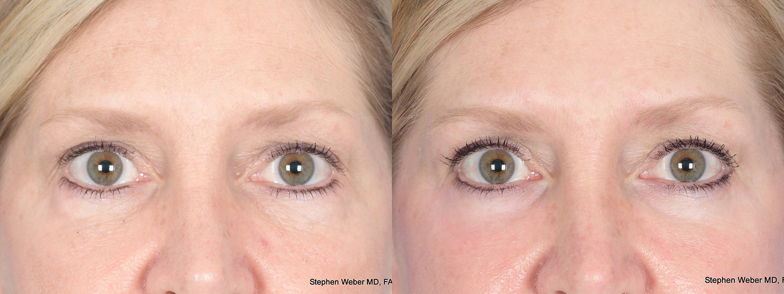 Before and After Eyelid Surgery in Denver 3