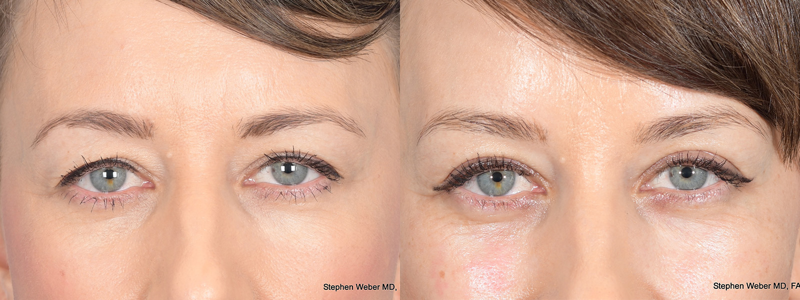Blepharoplasty Before and After | Weber Facial Plastic Surgery