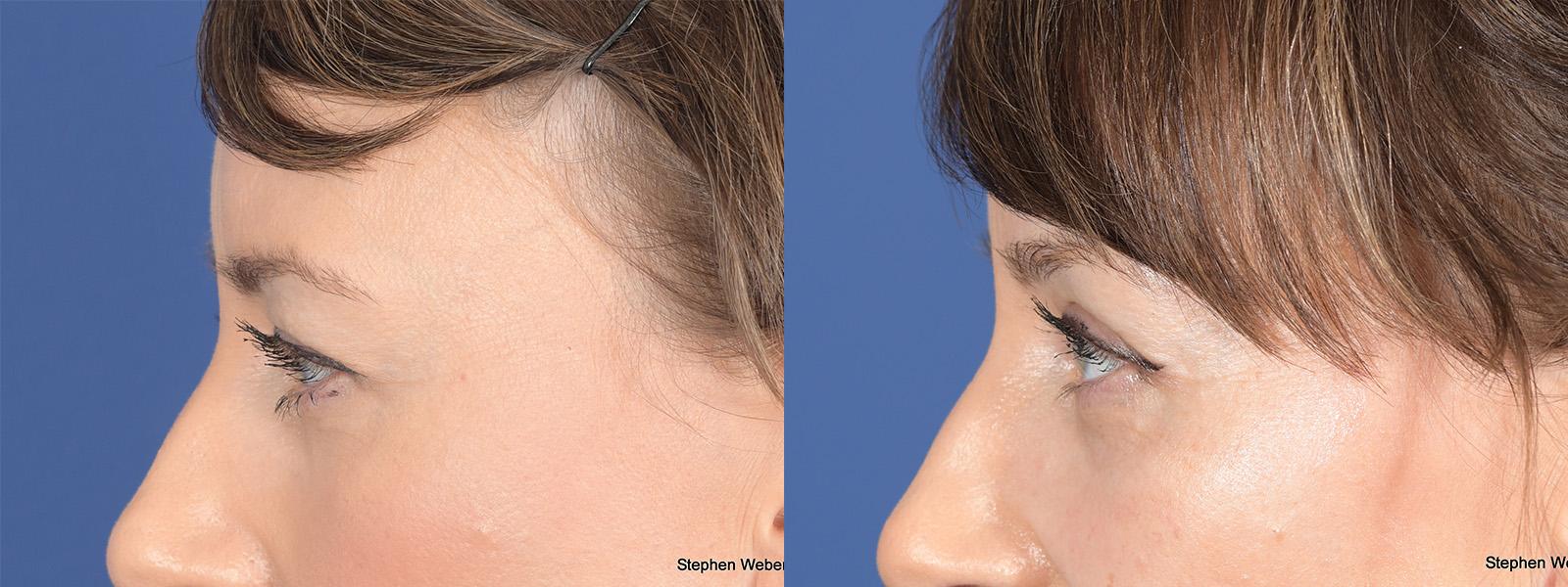 Blepharoplasty Before and After | Weber Facial Plastic Surgery