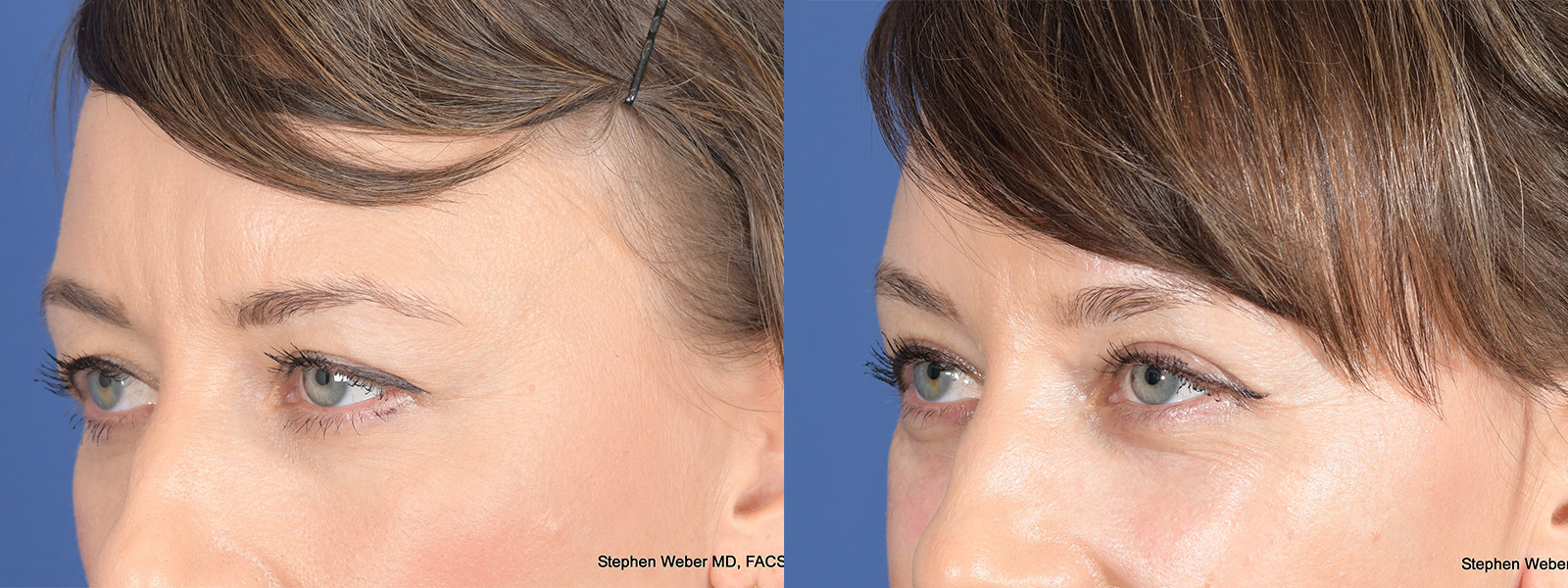 Blepharoplasty Before and After | Weber Facial Plastic Surgery