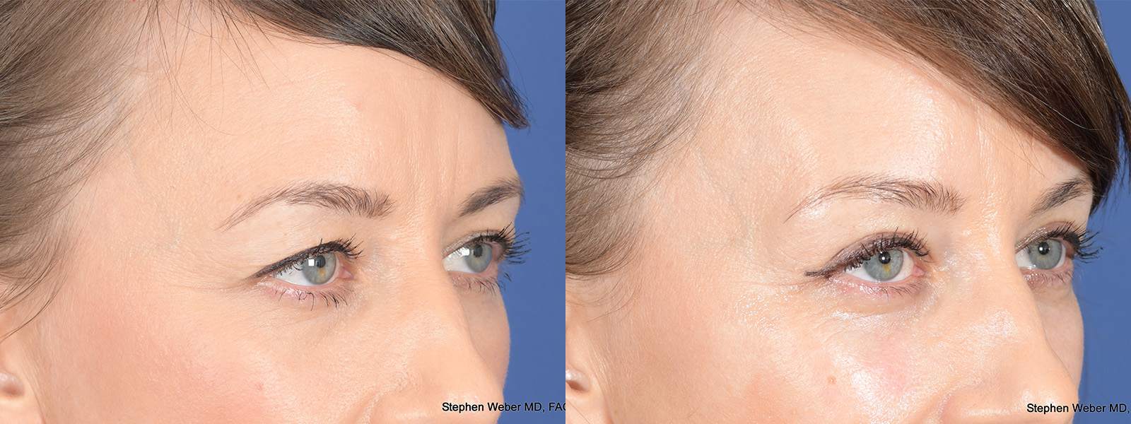 Blepharoplasty Before and After | Weber Facial Plastic Surgery