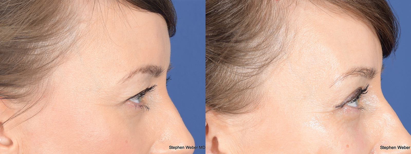 Blepharoplasty Before and After | Weber Facial Plastic Surgery
