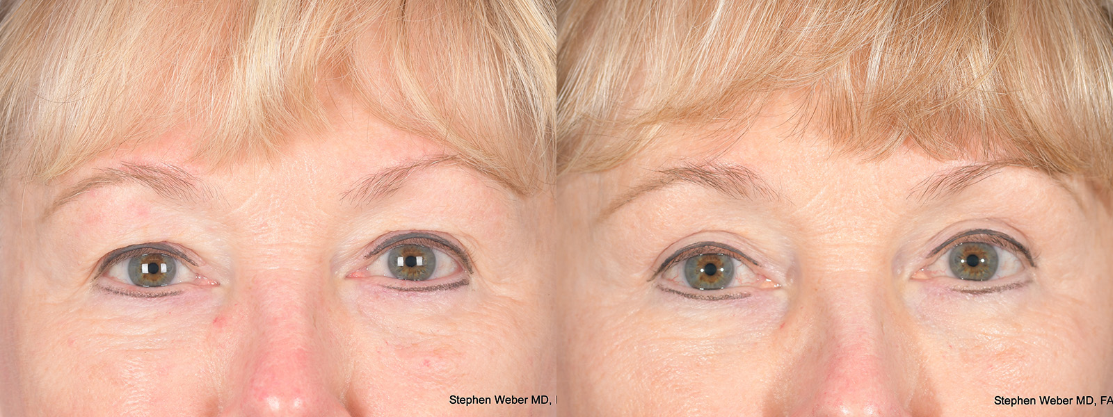 Blepharoplasty Before and After | Weber Facial Plastic Surgery