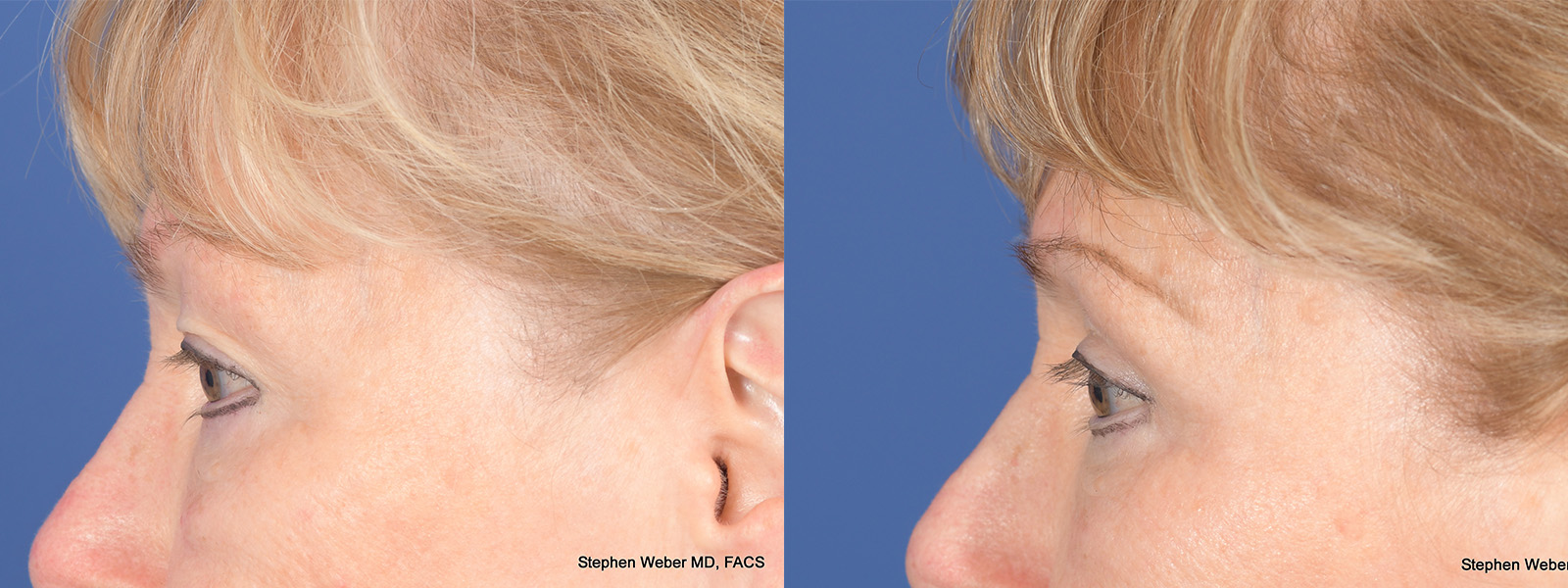 Blepharoplasty Before and After | Weber Facial Plastic Surgery