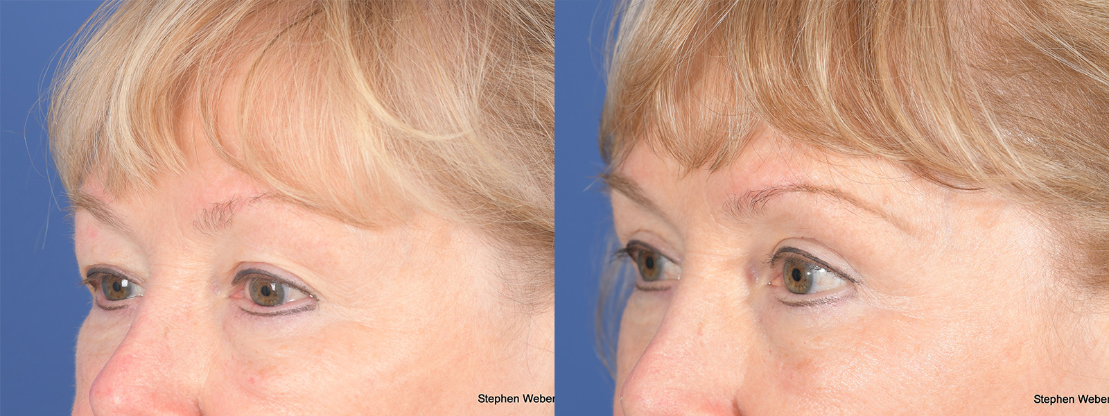 Blepharoplasty Before and After | Weber Facial Plastic Surgery