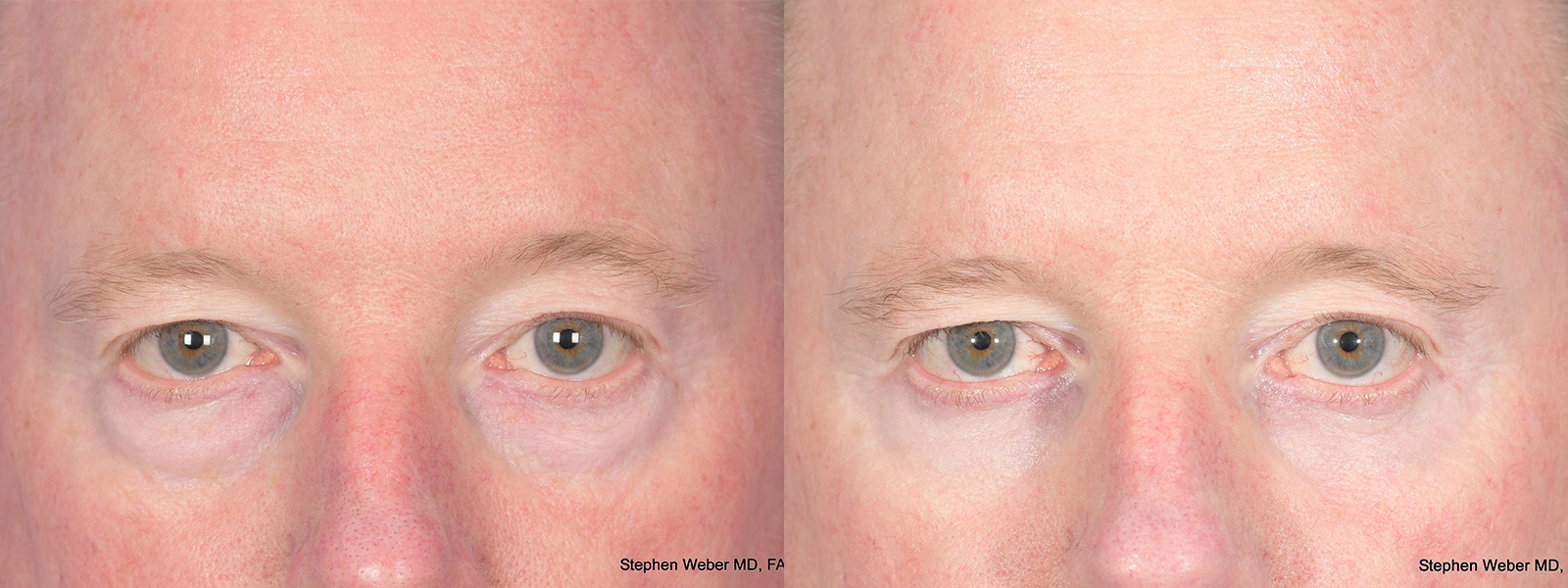 Blepharoplasty Before and After | Weber Facial Plastic Surgery