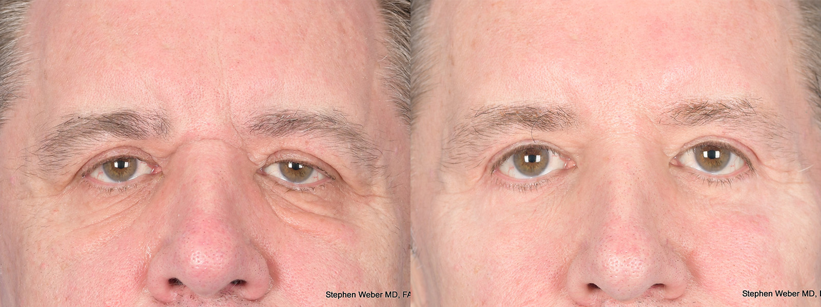 Blepharoplasty Before and After | Weber Facial Plastic Surgery