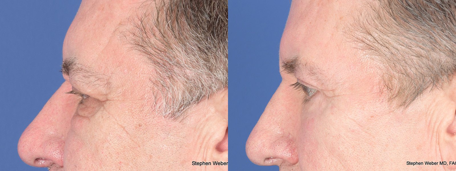 Blepharoplasty Before and After | Weber Facial Plastic Surgery