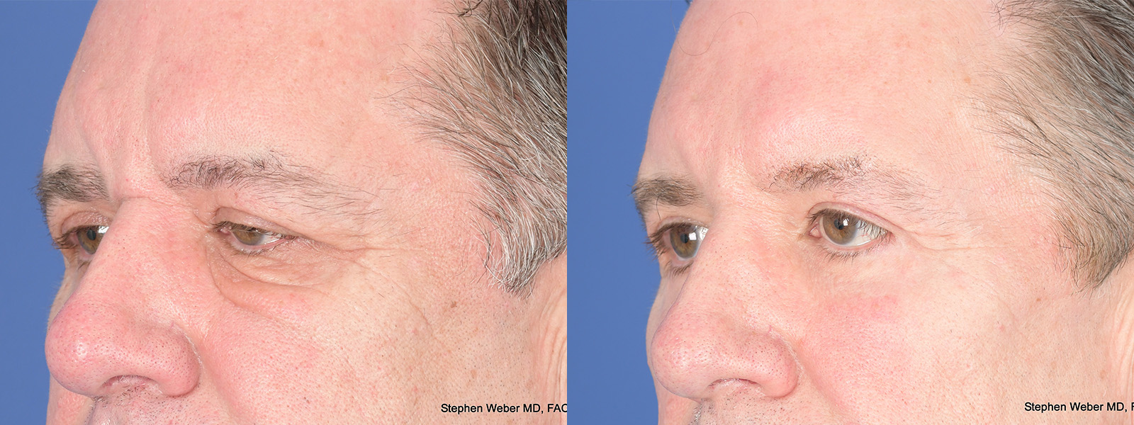 Blepharoplasty Before and After | Weber Facial Plastic Surgery