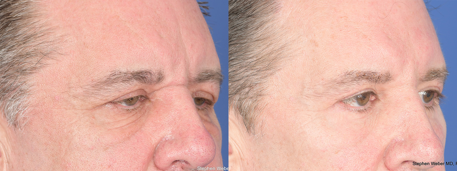 Blepharoplasty Before and After | Weber Facial Plastic Surgery