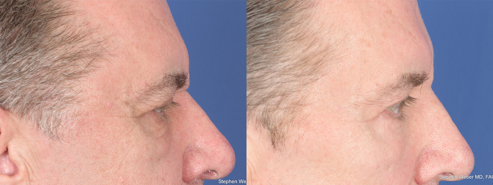 Blepharoplasty Before and After | Weber Facial Plastic Surgery
