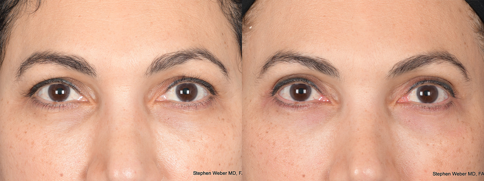 Before and After Eyelid Surgery in Denver 4