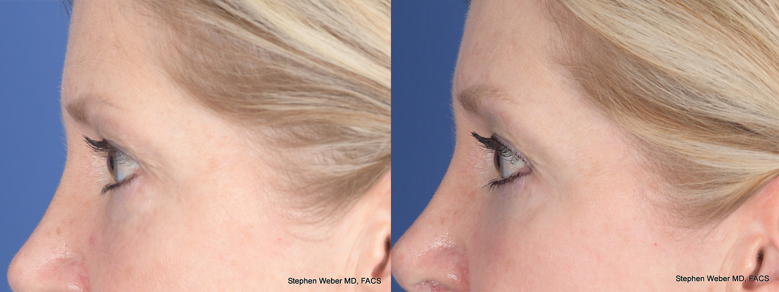 Blepharoplasty Before and After | Weber Facial Plastic Surgery