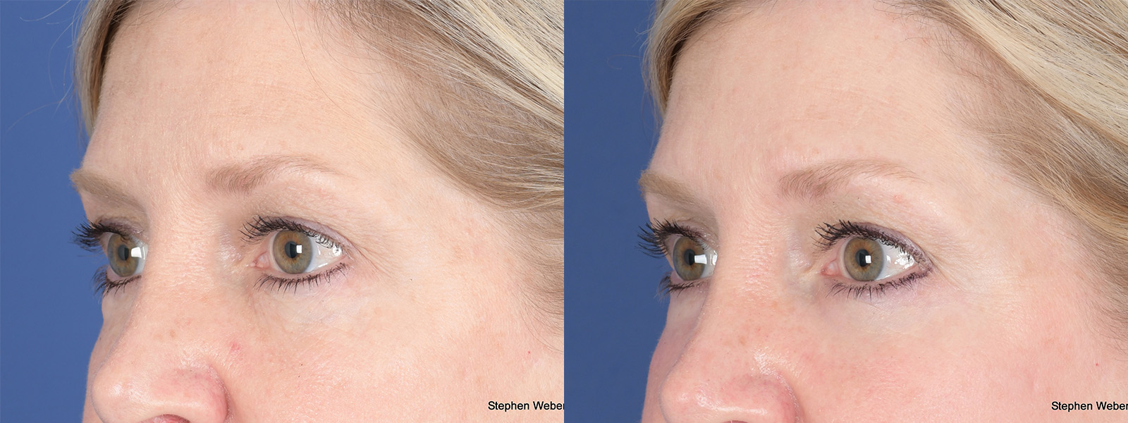 Blepharoplasty Before and After | Weber Facial Plastic Surgery
