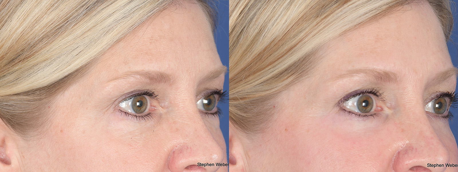 Blepharoplasty Before and After | Weber Facial Plastic Surgery