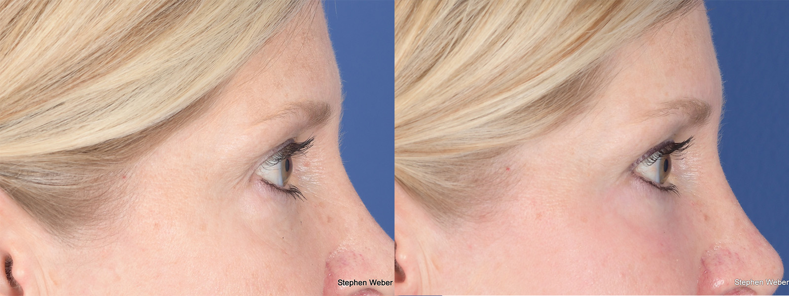 Blepharoplasty Before and After | Weber Facial Plastic Surgery