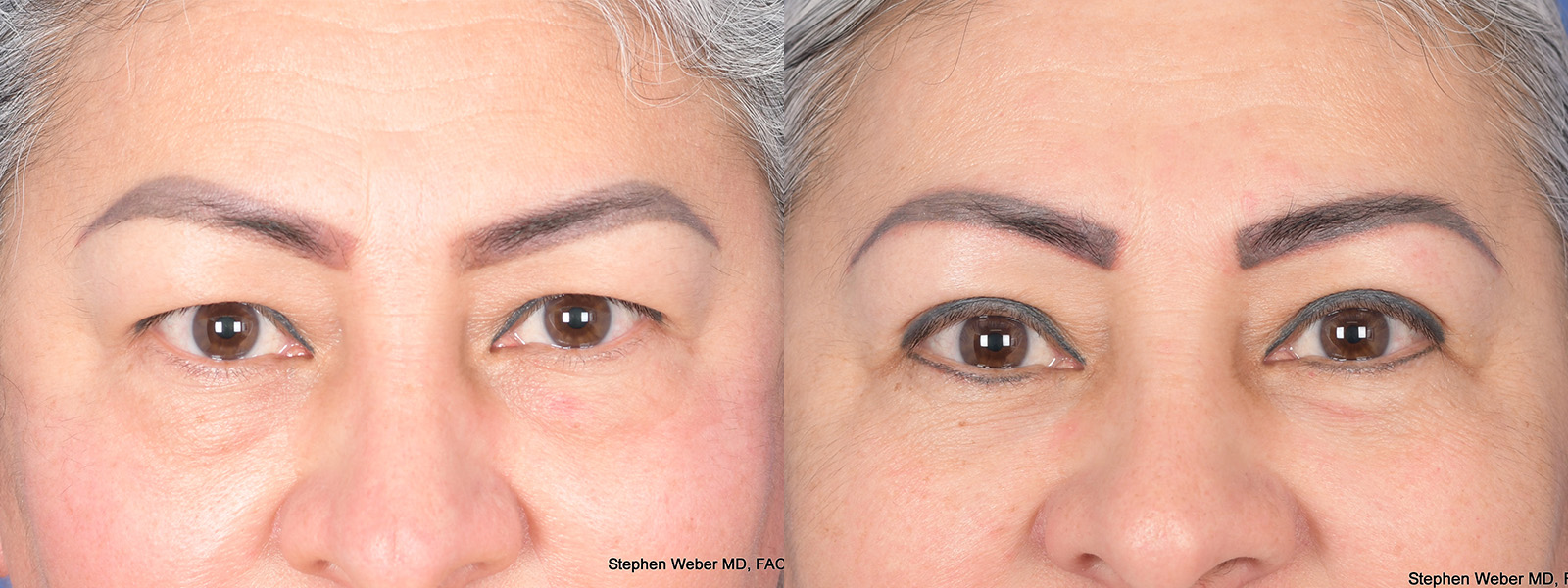 Blepharoplasty Before and After | Weber Facial Plastic Surgery