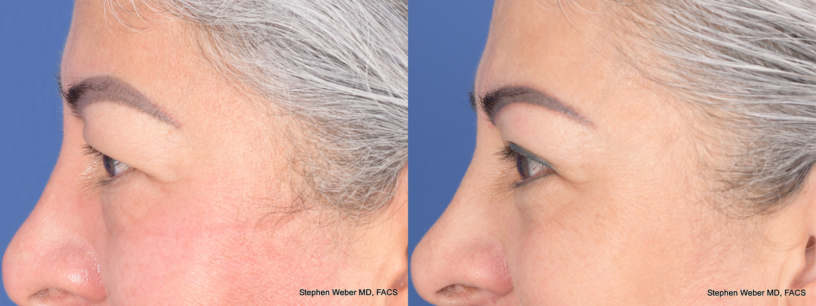 Blepharoplasty Before and After | Weber Facial Plastic Surgery