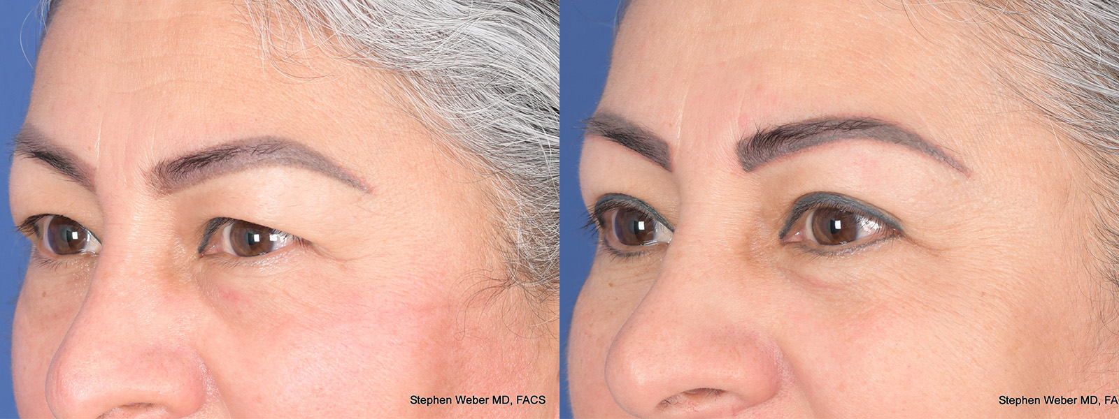 Blepharoplasty Before and After | Weber Facial Plastic Surgery