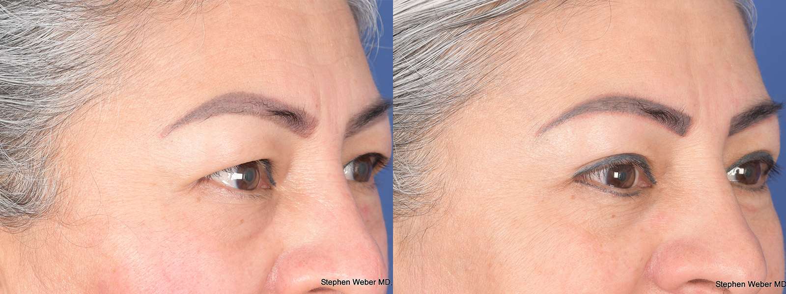 Blepharoplasty Before and After | Weber Facial Plastic Surgery