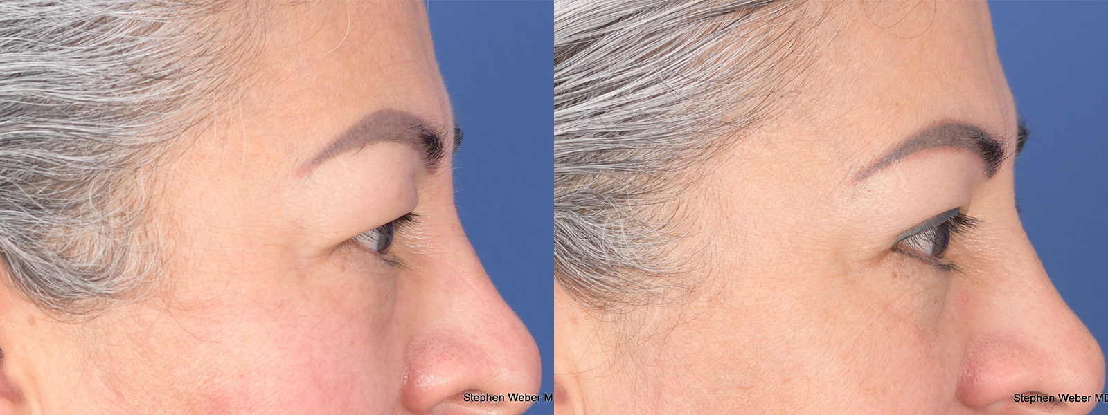 Blepharoplasty Before and After | Weber Facial Plastic Surgery