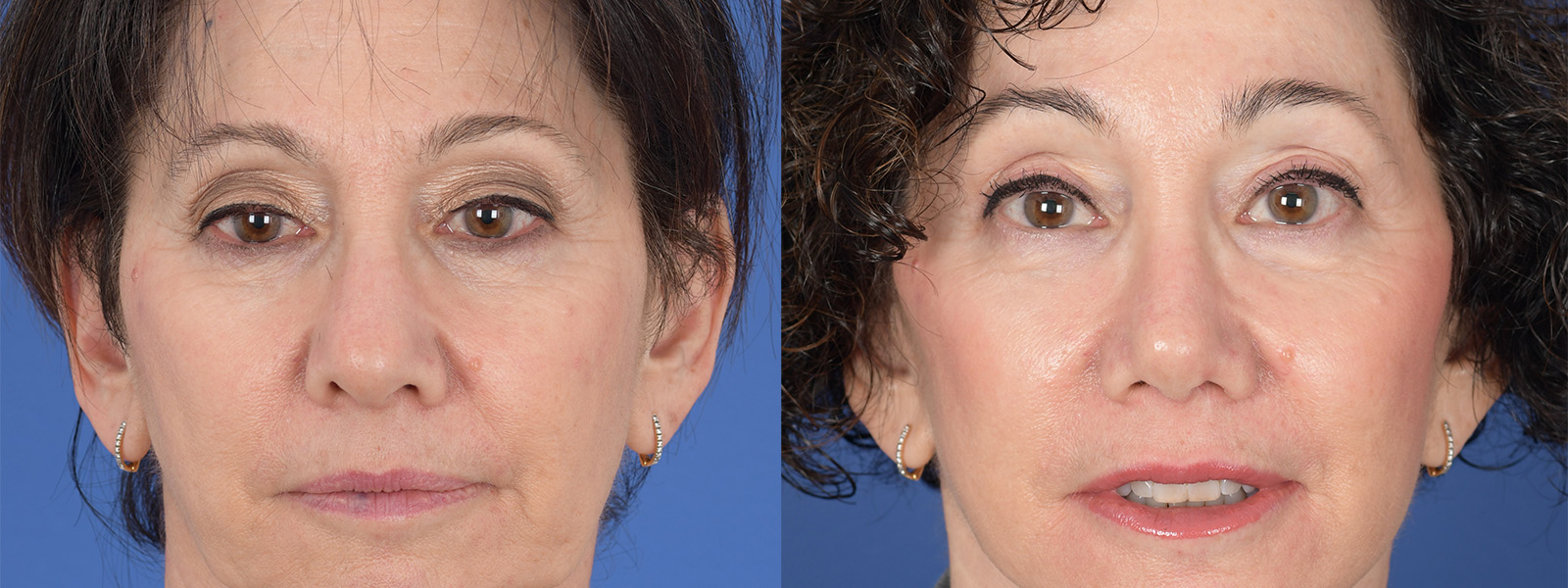 Blepharoplasty Before and After | Weber Facial Plastic Surgery